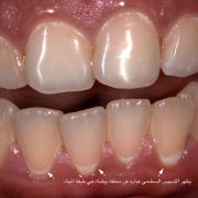 Does dental restoration considered treatment for dental caries?