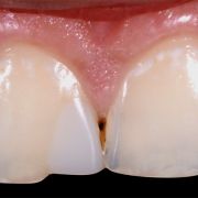 LAYERING COMPOSITE FOR BETTER ESTHETIC!