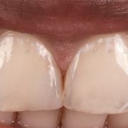 LAYERING COMPOSITE FOR BETTER ESTHETIC!