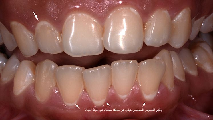 Does dental restoration considered treatment for dental caries?