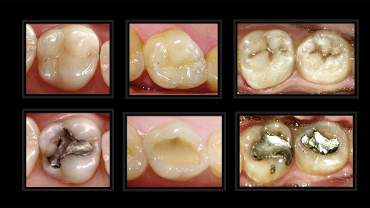 Risk profile and quality of dental restorations: A cross-sectional study