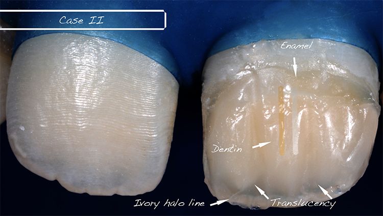 A natural-looking composite restoration: when Science meets Practice (Jeddah)