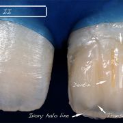 A natural-looking composite restoration: when Science meets Practice (Jeddah)