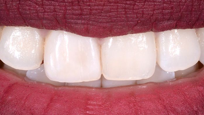 Anterior Composite restoration ... IS IT EASY TO MATCH THE NEXT TOOTH?!