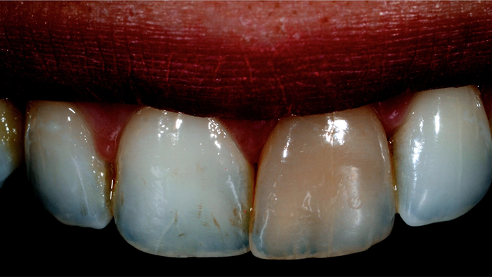 Single Discolored tooth ... CONSERVATIVE APPROACH