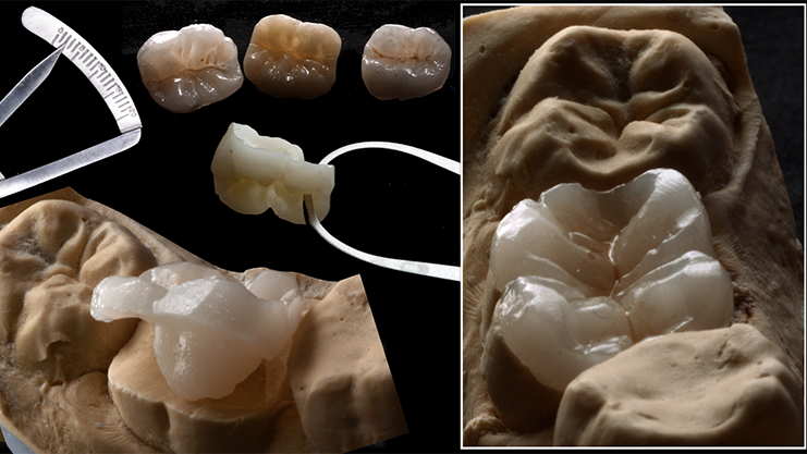 Restoring root canal treated tooth... A Conservative approach!