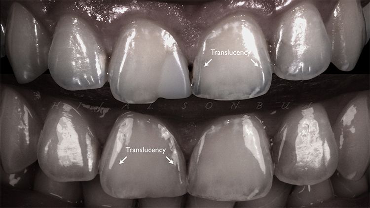 LAYERING COMPOSITE FOR BETTER ESTHETIC!