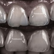 LAYERING COMPOSITE FOR BETTER ESTHETIC!